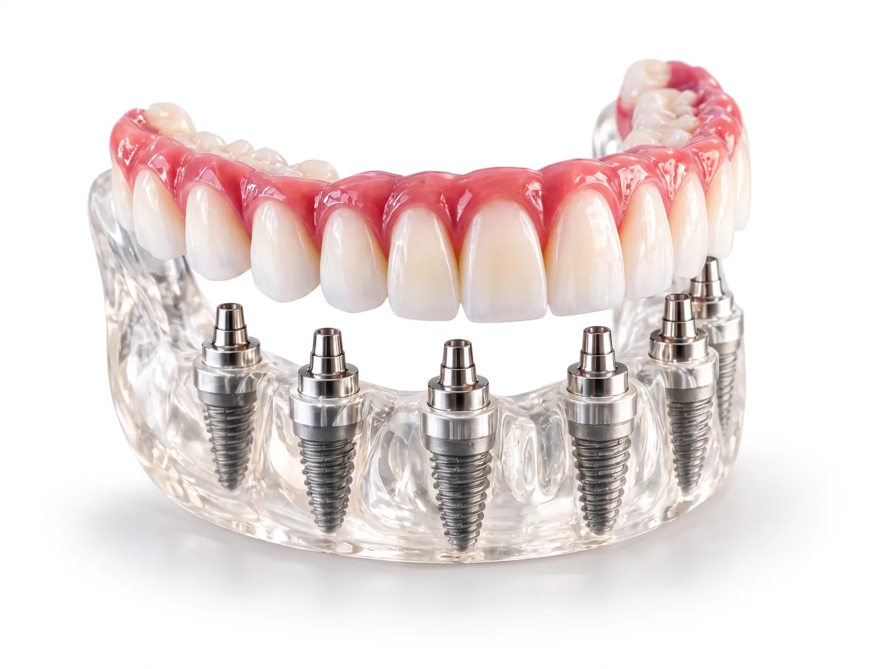 Modèle d’un traitement All-on-6 : un bridge fixe de dents au-dessus de six implants en titane, dans une mâchoire transparente